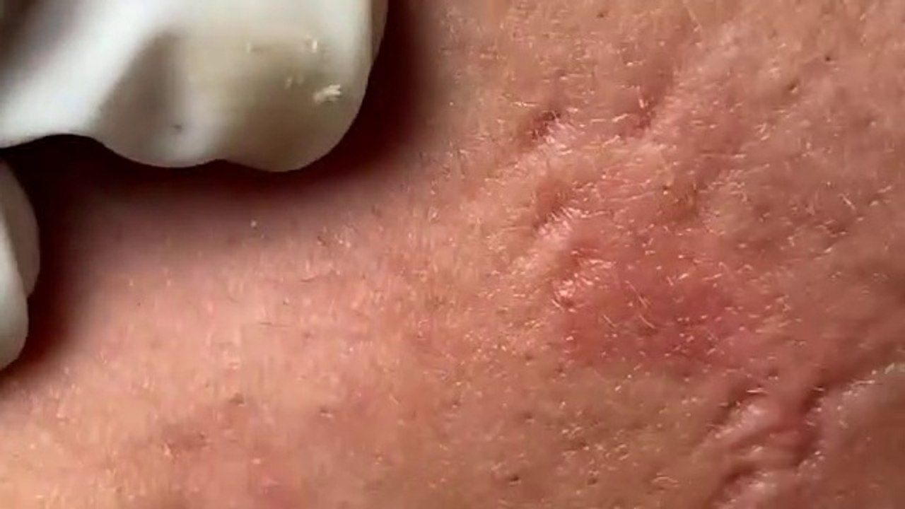 Make your Acne Treatment Huong Da Nang (7)