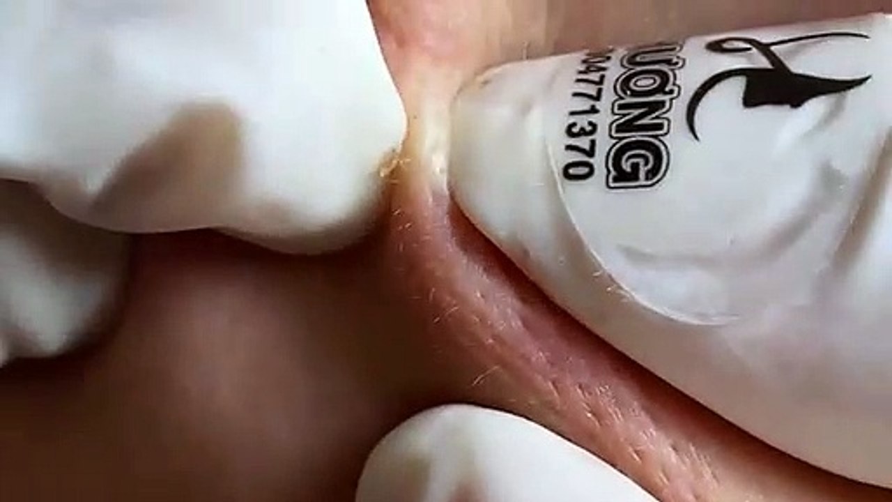 Make your Acne Treatment Huong Da Nang (8)