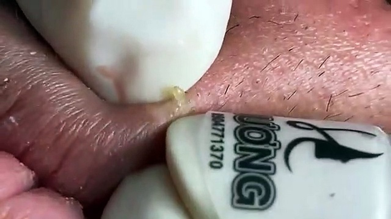 Make your Acne Treatment Huong Da Nang (9)