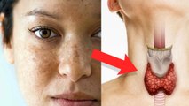 चेहरे पर काले धब्बे होना Thyroid Symptoms | Face Black Spots से Thyroid कैसे होता है | Boldsky