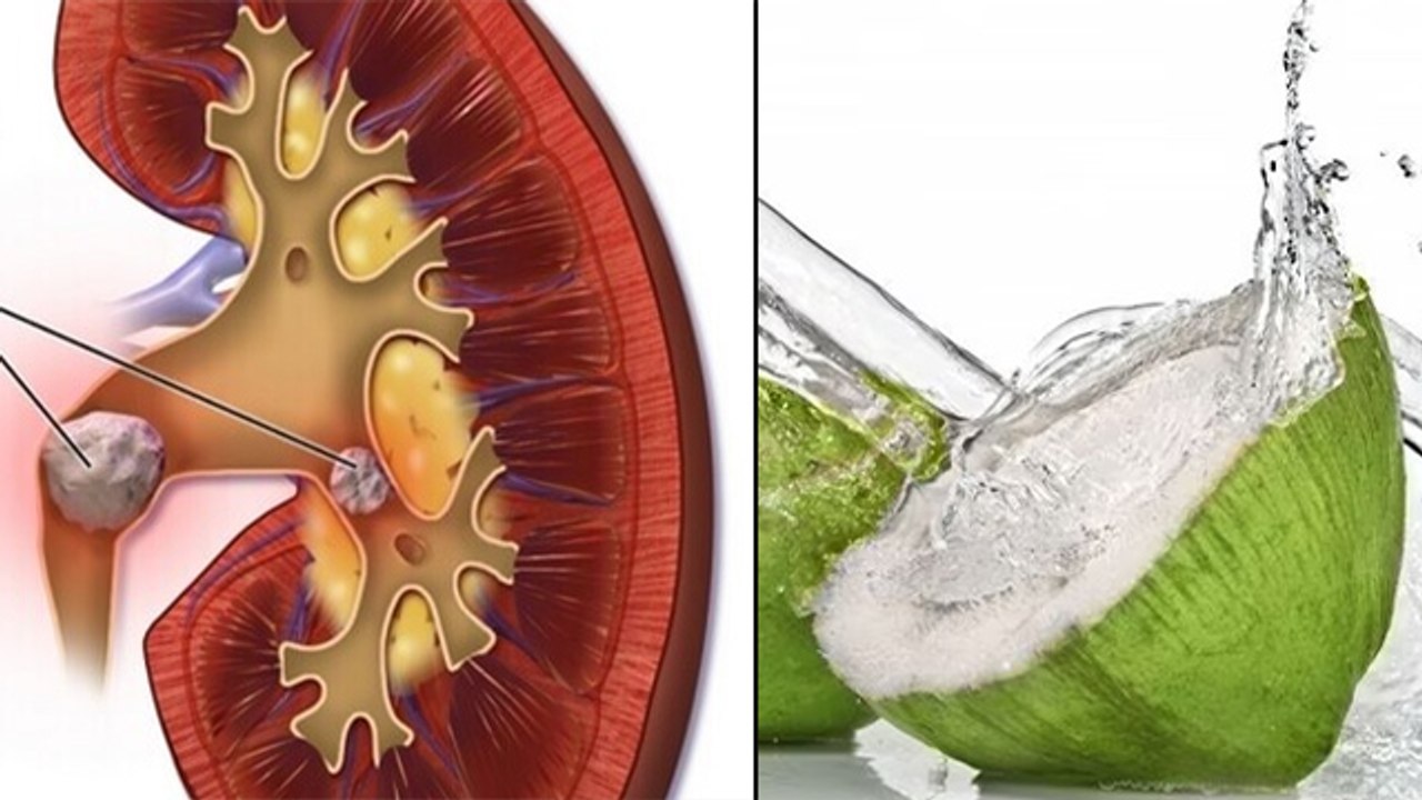 Kidney Stone में Coconut Water पीना चाहिए या नहीं । पथरी में नारियल पानी के फायदे । Boldsky