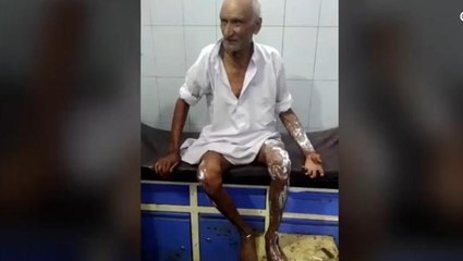 बुलंदशहर में बुजुर्ग पर उड़ेला "खौलता तेज़ाब", सोते समय हुई खौफ़नाक वारदात