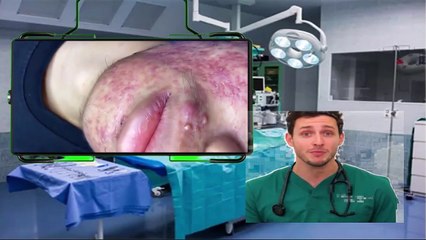 fatty pills | skin grains | epidermis | skin treatment | skincare | Satisfying Relaxing with Sac Dep Sp#1 Video | Relax |