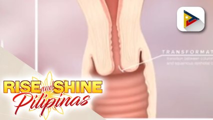 SAY ni DOK | Cervical Cancer