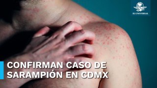 Confirman caso de sarampión en el Aeropuerto Internacional de CDMX