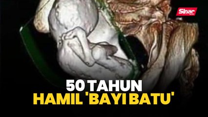 50 tahun hamil 'bayi batu'