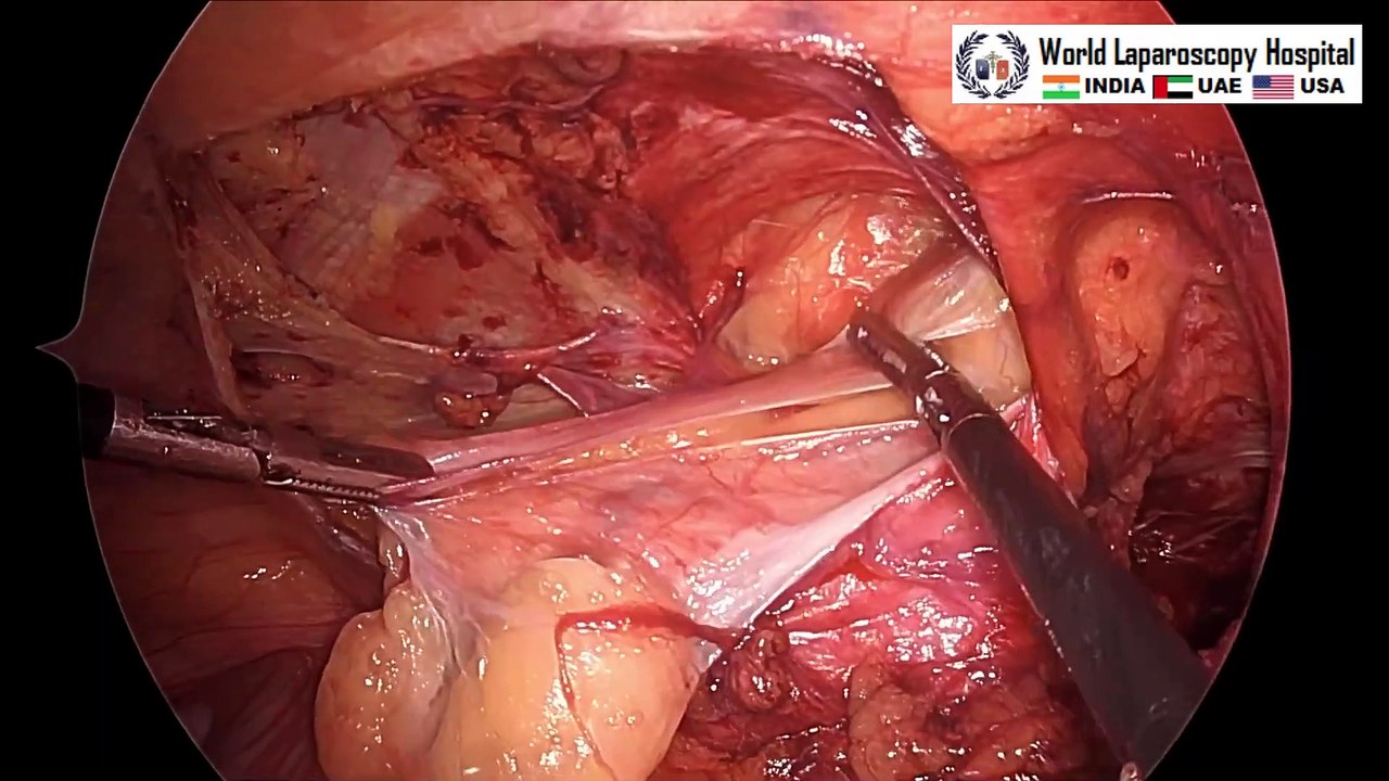 Bilateral Inguinal Hernia with Left sided Sliding Inguinal Hernia
