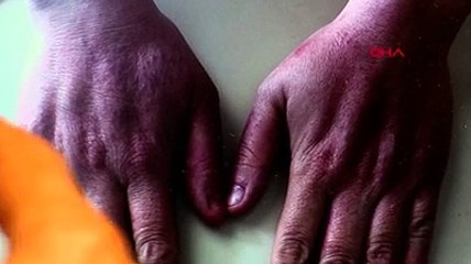 Korona virüs hastalarında önemli çalışma: 210 hastada görüldü