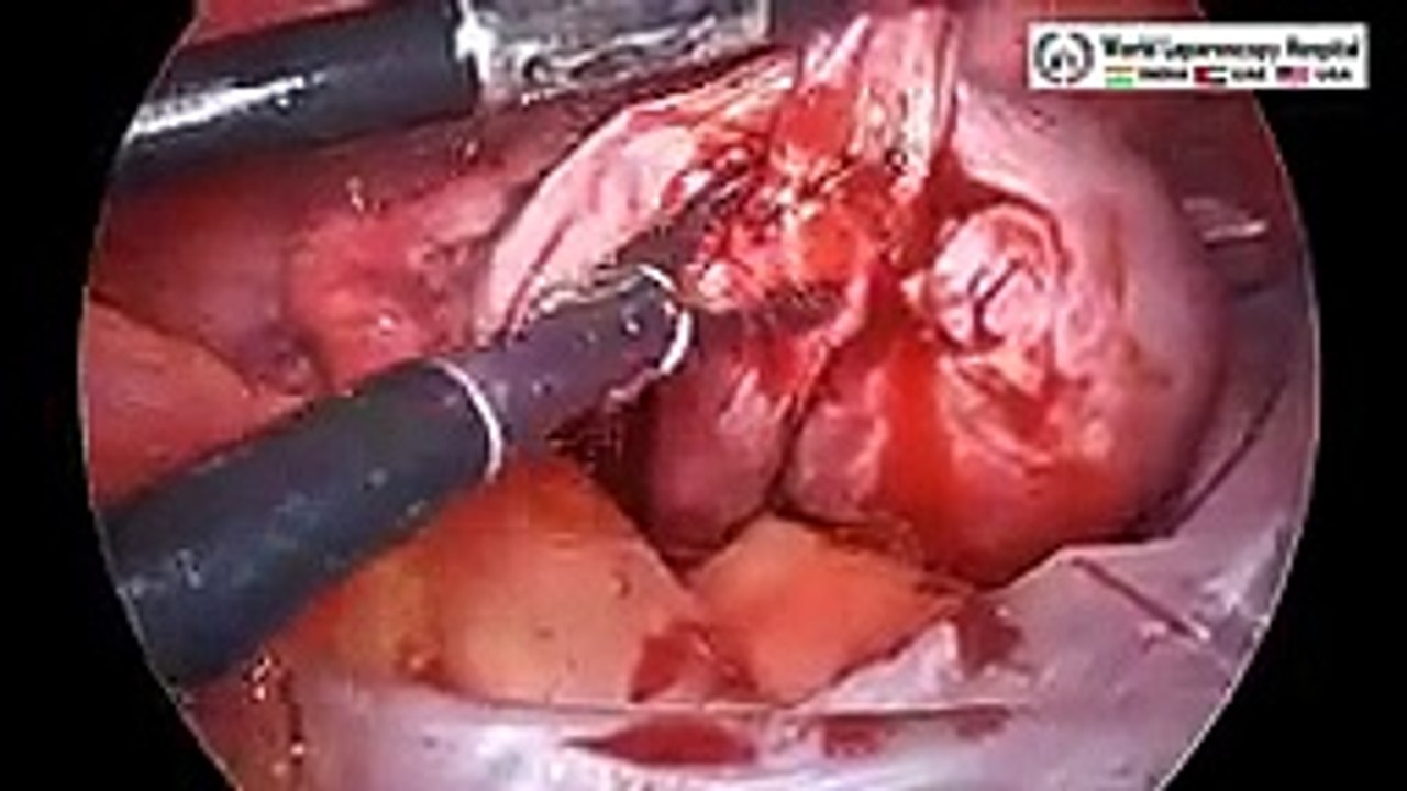 Precision and Care by Laparoscopy_ Laparoscopic Approach to Left Ovarian Endometrioma Resection