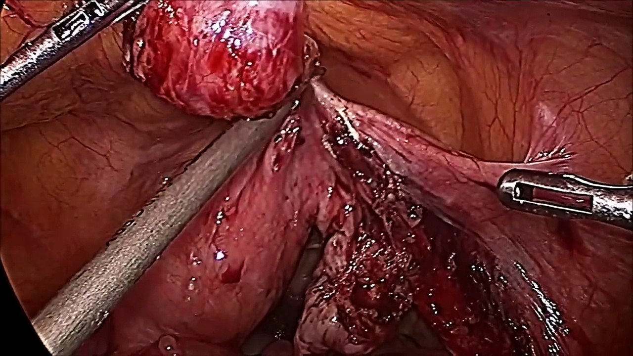 Bilateral Salpingectomy with Appendicectomy - Dr R K Mishra