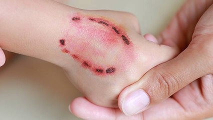 Un Hombre De Florida Contrae Un Virus Carnívoro Tras Ser Mordido