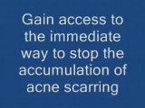 Acne Solutions, Cures, Medications, Treatments, STOP IT!