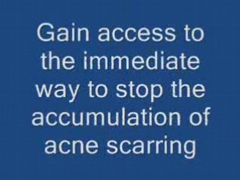 Acne Solutions, Cures, Medications, Treatments, STOP IT!