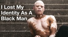 Acne Meds Gave Me Vitiligo - Now I'm Finally Dating | DATING DIFFERENT