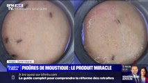 Cette crème sera peut-être la solution miracle contre les piqûres de moustique