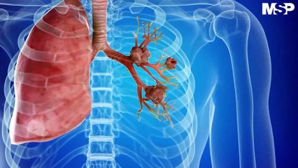 Cáncer de Pulmón: Factores de riesgo y herramientas de diagnóstico #MSPOncología