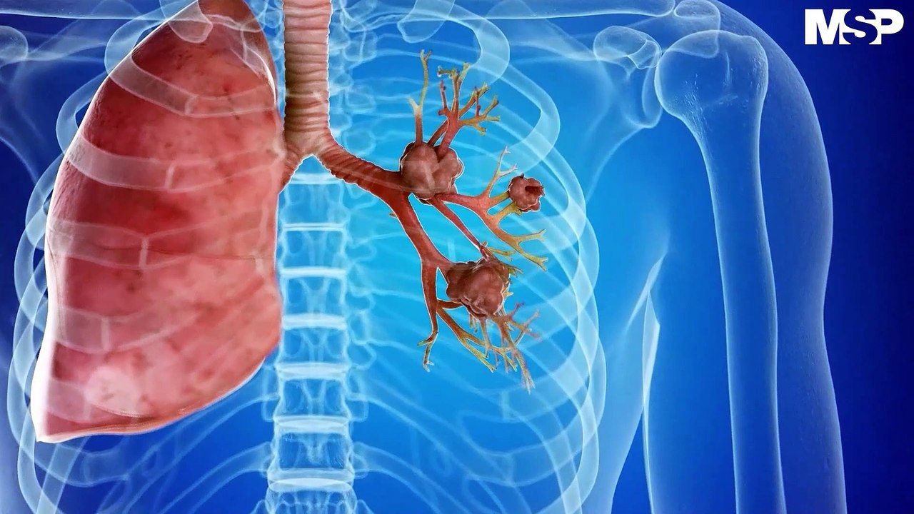 Cáncer de Pulmón: Factores de riesgo y herramientas de diagnóstico #MSPOncología