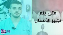 متى يتم تجبير الأسنان