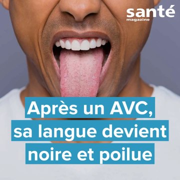 Après un AVC, sa langue devient noire et poilue