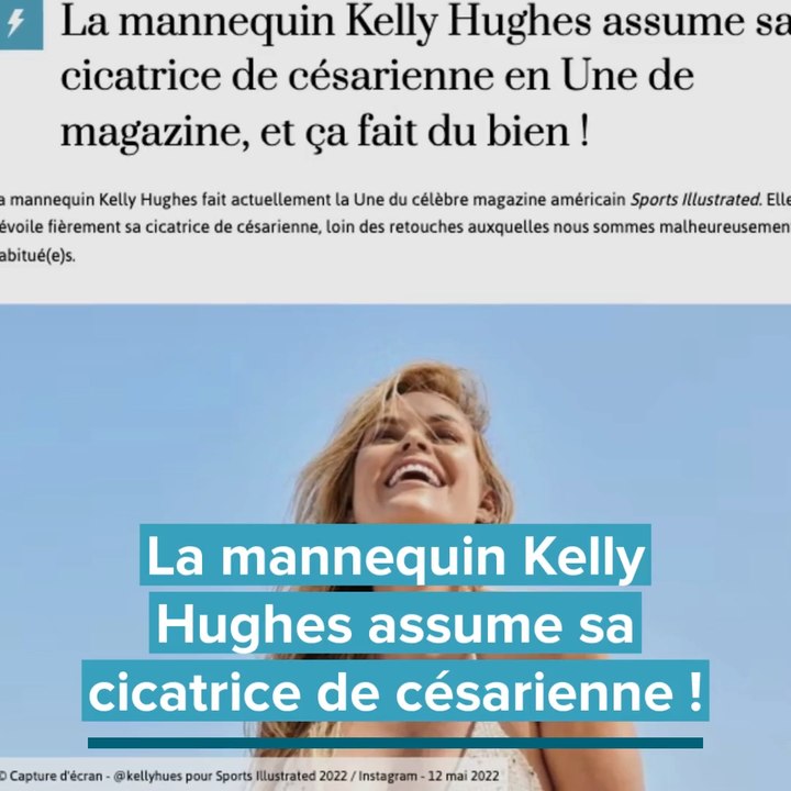 Une top modèle affiche sa cicatrice de césarienne
