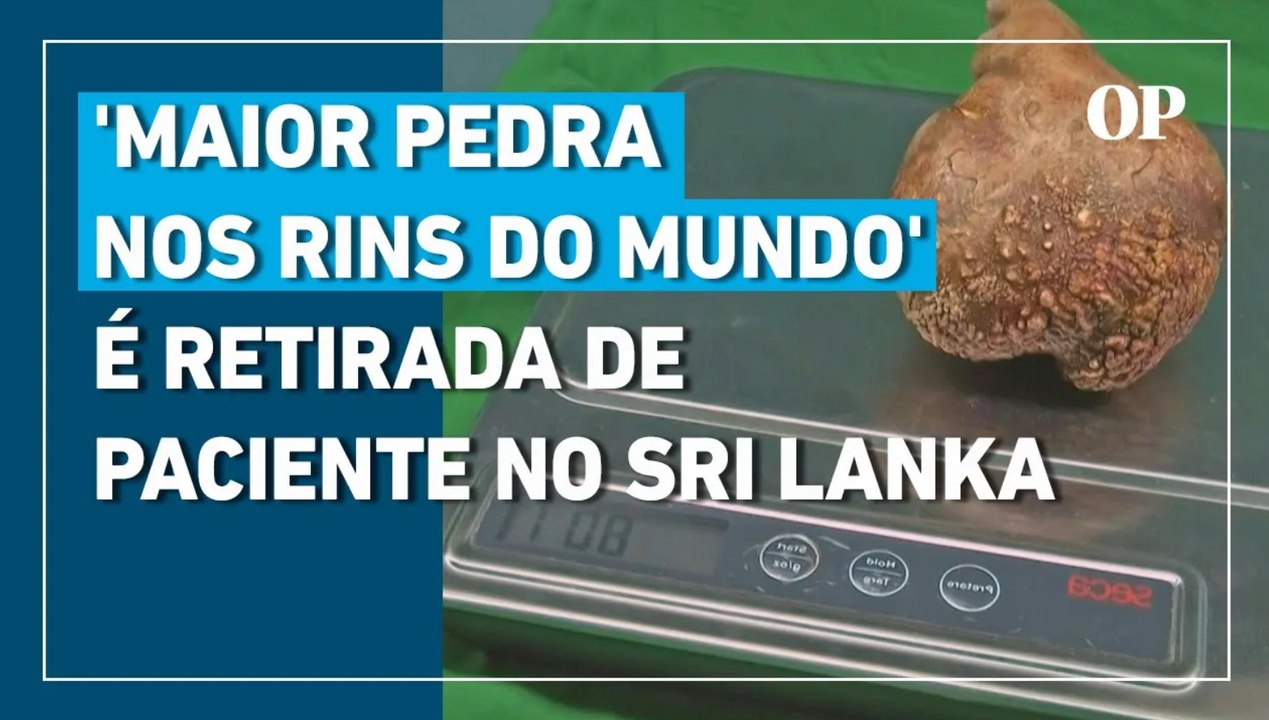 Maior pedra nos rins do mundo é retirada de paciente no Sri Lanka ...