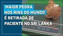 Maior pedra nos rins do mundo é retirada de paciente no Sri Lanka