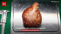 Extirpan el cálculo renal más grande del mundo a paciente en Sri Lanka; obtiene récord guinness