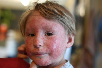 Toddler with extreme eczema seeking donations for life-changing treatment