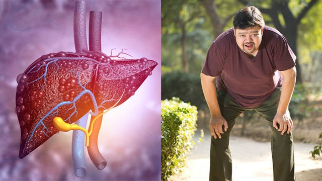 फैटी लिवर थकान और कमजोरी का कारण है क्या | Fatty Liver Thakan aur Kamjori ka Karan Hai Kya | Boldsky