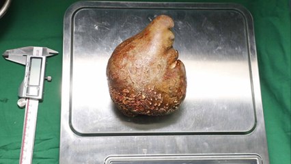 Größter Nierenstein der Welt in Sri Lanka entfernt