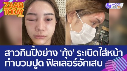 เกือบเสียโฉม! สาวเจอกุ้งระเบิดใส่หน้า - ขณะกินปิ้งย่าง ทำหน้าบวมปูด ฟิลเลอร์อักเสบ (16 มิ.ย. 66) แซ่บทูเดย์