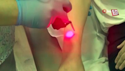 Uzmanından merdiven altı lazer epilasyon uyarısı