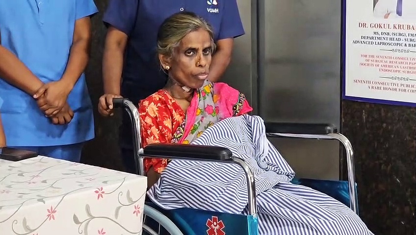 பெண்ணின் வயிற்றில் 36 கிலோ கட்டி.. அரிய அறுவை சிகிச்சை செய்து கோவை மருத்துவர்கள் சாதனை