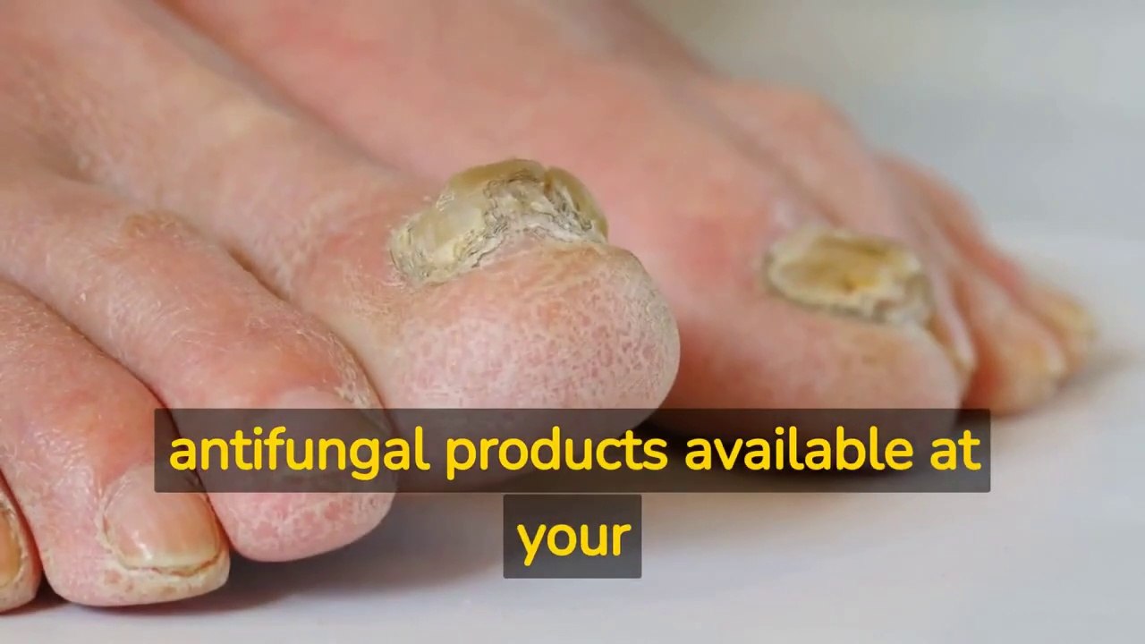 Metanail Complex, Metanail Complex Reviews 2023 - Metanail Complex Fungus Vanishing Review