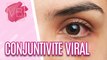 Conjutivite viral: o que é, causas e tratamentos - Você Bonita (19/06/2023)