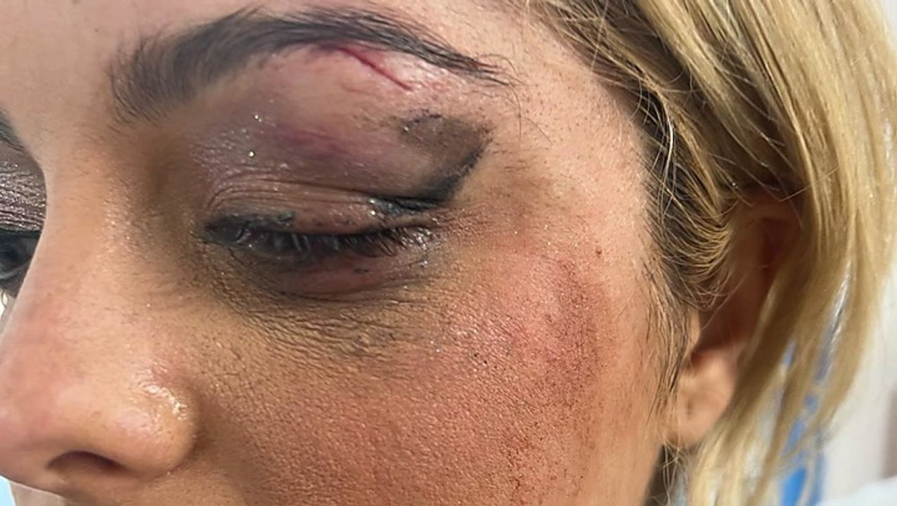 Bebe Rexha auf Bühne mit Handy beworfen: Krasse Bilder zeigen Platzwunde