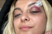 Bebe Rexha has reassured her fans after being hit in the face by a phone