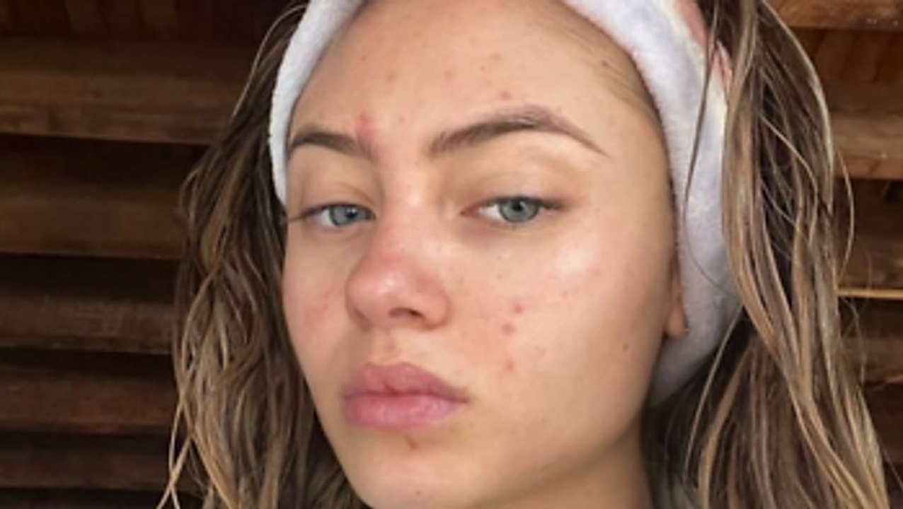 Leni Klum steht dazu: Sie zeigt ihre Unreinheiten