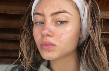 Leni Klum displays candid image of skin break-outs