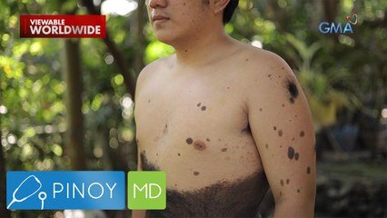 Nunal na sakop ang halos kalahati ng katawan, may epekto ba sa kalusugan? | Pinoy MD