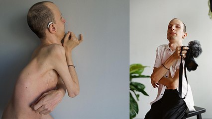 Stone Man Syndrome क्या है | 29 Age में Joe Sooch Body क्यों बन रही Stone, Reason चौंकाने वाला