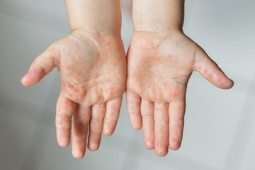 TPHCM đã tiếp cận được thuốc Immunoglobulin chữa bệnh tay chân miệng