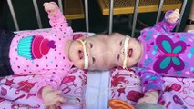 Conjoined twins given 2% survival chance graduate kindergarten