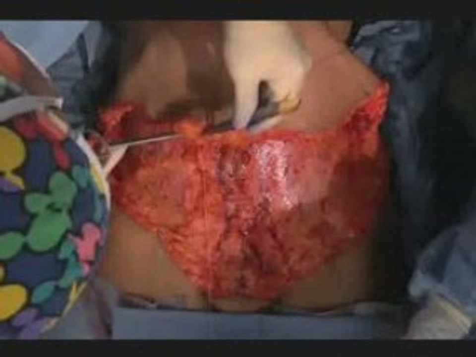 Video of a Tummy Tuck Procedure