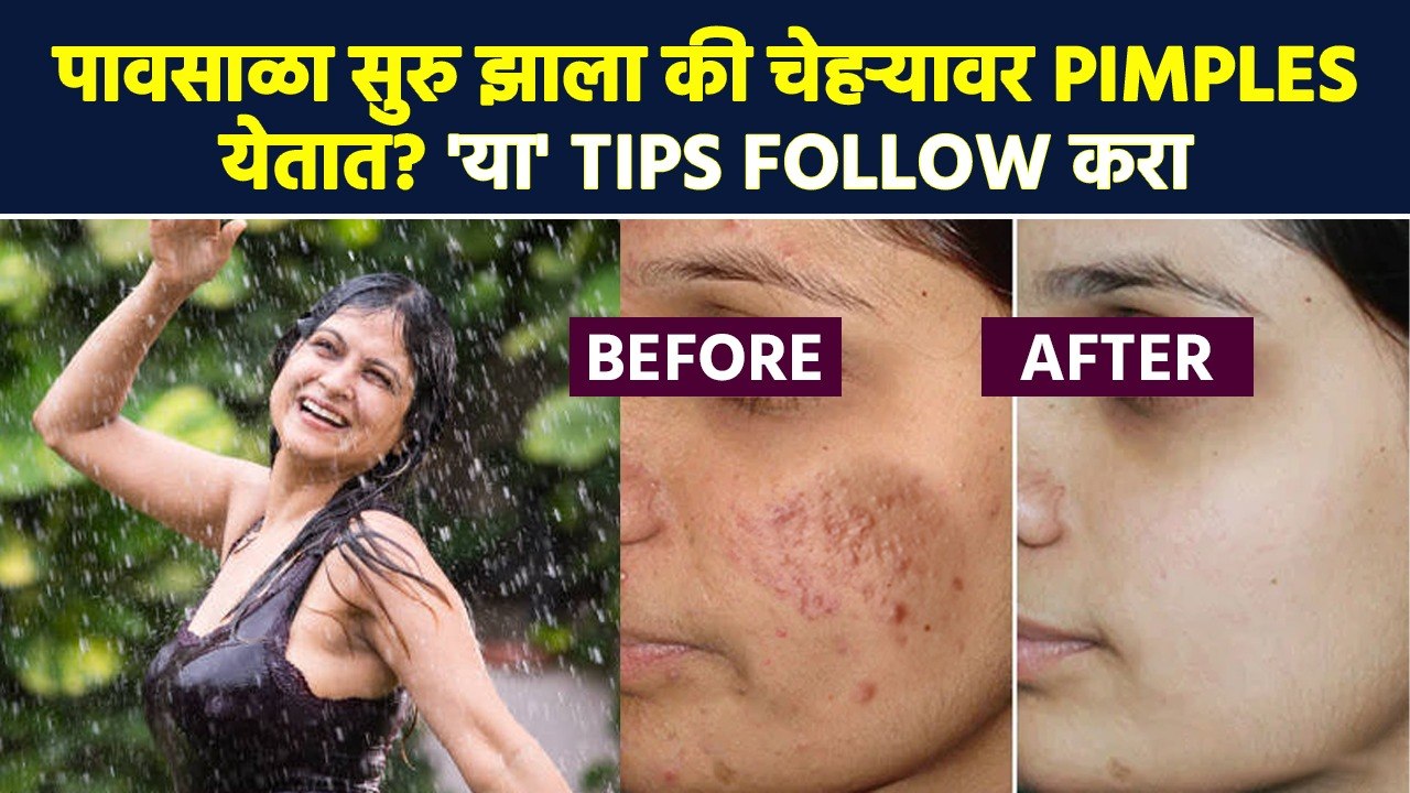 पावसामुळे चेहऱ्यावर Pimples येतात? लगेचच 'हे' उ...