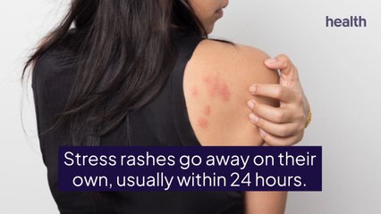 Stress Rashes and Stress Hives—Here's What To Know