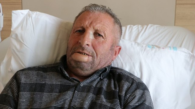 Her şey küçük bir yarayla başladı… Kol derisinden yeni dudak yapıldı