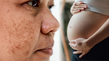 Download Video: Pregnancy के बाद Pigmentation कैसे हटाएं | चेहरे से झाइयां हटाने का तरीका | Boldsky