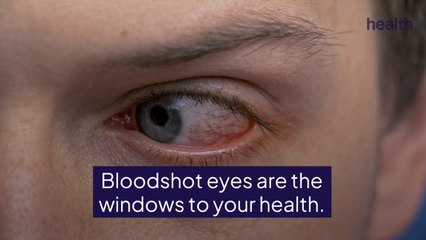 8 Reasons Your Eyes Are Red and Bloodshot—and How To Treat Them