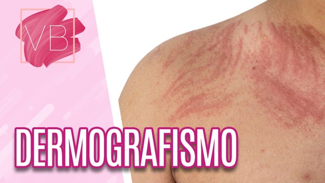 Saiba o que é dermografismo e como lidar quando a alergia ataca - Você Bonita (30/06/2023)